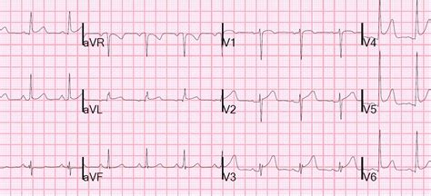 st elevation probably early repolarization.